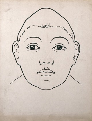 Child's head with large temporal lobes and depressed frontal lobe. Drawing, c. 1900.