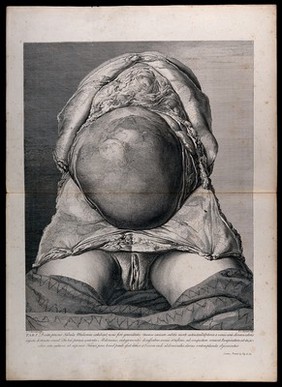 Initial dissection of the pregnant female abdomen, showing the skin peeled away to reveal the swollen uterus. Copperplate engraving by F.S. Ravenet after I.V. Rymsdyk, 1774, reprinted 1851.