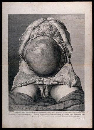 Initial dissection of the pregnant female abdomen, showing the skin peeled away to reveal the swollen uterus. Copperplate engraving by F.S. Ravenet after I.V. Rymsdyk, 1774, reprinted 1851.