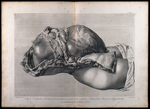 Dissection of the pregnant female abdomen, showing the skin peeled away to reveal the swollen uterus and the viscera, side view. Copperplate engraving by G. Scotin after I.V. Rymsdyk, 1774, reprinted 1851.