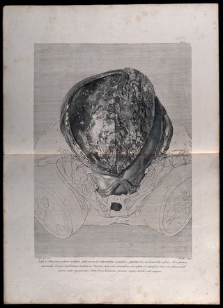 Dissection of the pregnant uterus: initial view of the opened womb. Copperplate engraving by J.S.(?) Müller after I.V. Rymsdyk, 1774, reprinted 1851.