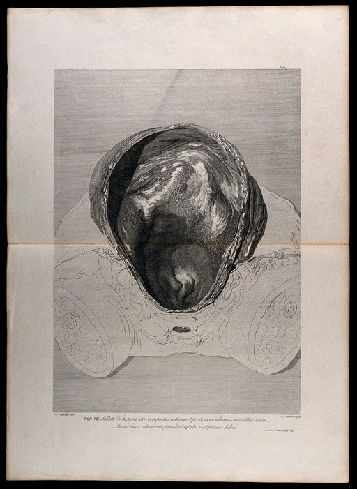 Front view of the cavity of the uterus, after the removal of a foetus: the investing membranes still adhering. Engraving by F.S. Ravenet after I.V. Rymsdyk, 1774, reprinted 1851.