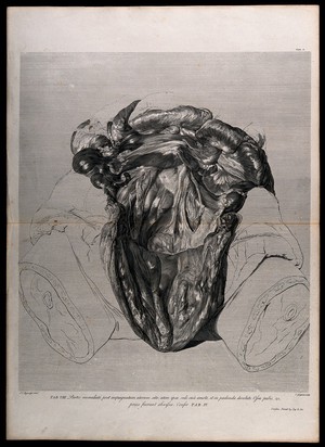 view Dissection made after the removal of a pregnant uterus, showing the parts lying immediately behind. Copperplate engraving by C. Grignion after I.V. Rymsdyk, 1774, reprinted 1851.