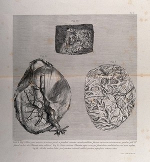 view The outer forepart of the uterus, the inside of the placenta and a portion of the internal surface of the uterus: three figures. Copperplate engraving by P.C. Canot after I.V. Rymsdyk, 1774, reprinted 1851.