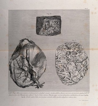 The outer forepart of the uterus, the inside of the placenta and a portion of the internal surface of the uterus: three figures. Copperplate engraving by P.C. Canot after I.V. Rymsdyk, 1774, reprinted 1851.