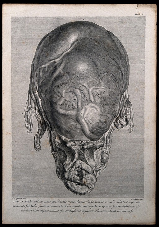 Front view of a pregnant uterus, taken from a woman who died of 'a flooding' in the ninth month of pregnancy. Copperplate engraving by P. Maleuve (Maleuvre?) after I.V. Rymsdyk, 1774, reprinted 1851.