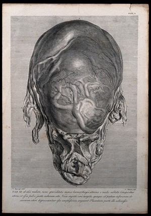 view Front view of a pregnant uterus, taken from a woman who died of 'a flooding' in the ninth month of pregnancy. Copperplate engraving by P. Maleuve (Maleuvre?) after I.V. Rymsdyk, 1774, reprinted 1851.