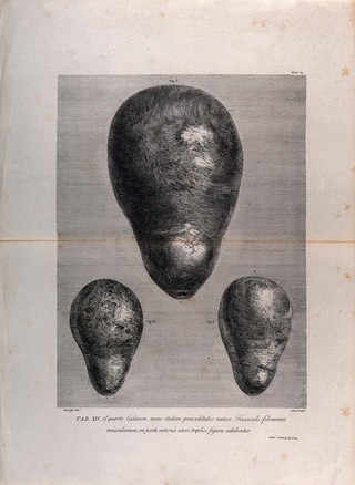 Three figures showing the muscular fasciculi on the inside of the pregnant uterus at nine months. Copperplate engraving by Menil after I.V. Rymsdyk, 1774, reprinted 1851.