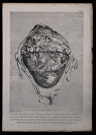 Dissection of the pregnant uterus at eight months. Copperplate engraving by J. Fougeron after I.V. Rymsdyk, 1774, reprinted 1851.