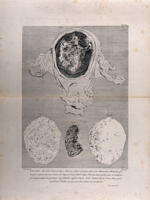 view Dissection of the pregnant uterus at six months, showing the placenta and the decidua: four figures. Copperplate engraving by Menil after J.V. Rymsdyk, 1774, reprinted 1851.