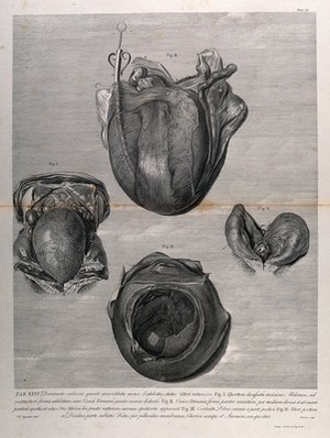 view Dissections of a retroverted pregnant uterus, shown with the bladder, at five months: two figures. Copperplate engraving by Aliamet after J.V. Rymsdyk, 1774, reprinted 1851.