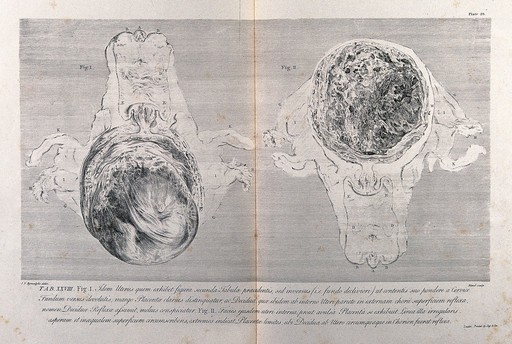 Dissections of a pregnant uterus at five months: two figures, one showing the foetus. Copperplate engraving by Menil after J.V. Rymsdyk, 1774, reprinted 1851.