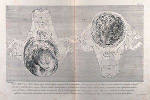 view Dissections of a pregnant uterus at five months: two figures, one showing the foetus. Copperplate engraving by Menil after J.V. Rymsdyk, 1774, reprinted 1851.