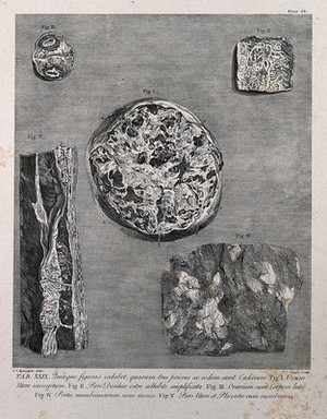 view Dissections showing parts of the pregnant uterus, decidua and ovum at nine months: five figures. Copperplate engraving by P.C. Canot after J.V. Rymsdyk, 1774, reprinted 1851.