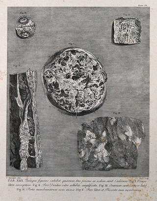 Dissections showing parts of the pregnant uterus, decidua and ovum at nine months: five figures. Copperplate engraving by P.C. Canot after J.V. Rymsdyk, 1774, reprinted 1851.