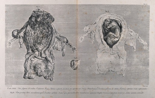Dissections of the pregnant uterus and the corpus luteum in the left overy, at five months: three figures. Copperplate engraving by E. Du Mesnil after J.V. Rymsdyk, 1774, reprinted 1851.