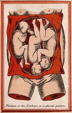 view Triplets, shown in the uterus: illustration showing the position of the foetuses in a plural position. Colour lithograph, 1850/1910?.