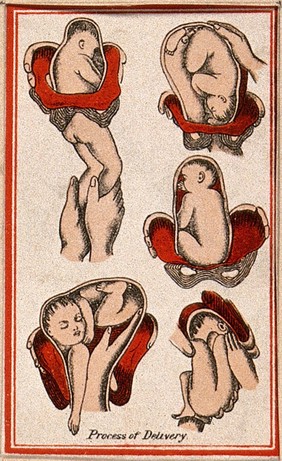 Birth of a baby: five figures, showing the process of delivery. Colour lithograph, 1850/1910?.