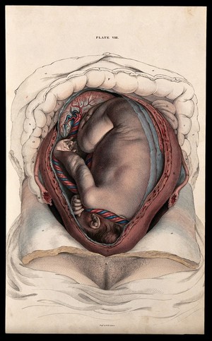 view Dissection of the uterus in the latter stages of pregnancy, showing the foetus, placenta and umbilical cord. Coloured line engraving by W.H. Lizars, ca. 1827.