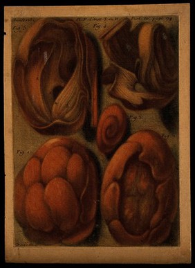 Five tumours in various states of dissection. Colour mezzotint by J.F. Gautier d'Agoty, 1752.