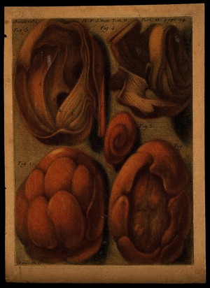 view Five tumours in various states of dissection. Colour mezzotint by J.F. Gautier d'Agoty, 1752.