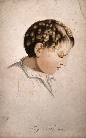 Head of a boy with skin disease. Coloured stipple engraving by S. Tresca after Moreau-Valvile, c.1806.