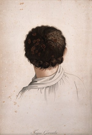 view Back of head showing skin disease. Coloured stipple engraving by S. Tresca after Moreau-Valvile, c. 1806.