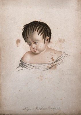 Head of an infant with hair disease. Coloured stipple engraving by S. Tresca after Moreau-Valvile, c. 1806.