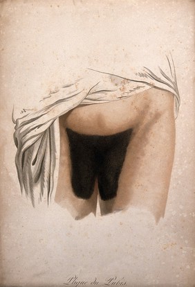 A female pubis with hair disease. Coloured stipple engraving by S. Tresca after Moreau-Valvile, c. 1806.