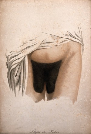 view A female pubis with hair disease. Coloured stipple engraving by S. Tresca after Moreau-Valvile, c. 1806.