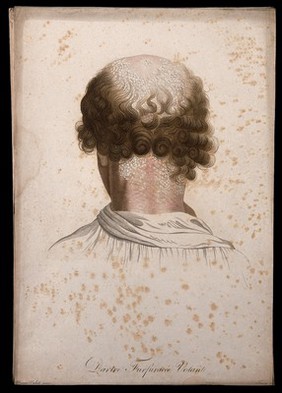 Head of a man with skin disease; back view. Coloured stipple engraving by S. Tresca after Moreau-Valvile, c. 1806.