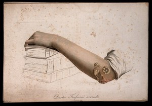 view A forearm with a skin disease on the elbow. Coloured stipple engraving by S. Tresca after Moreau-Valvile, c. 1806.