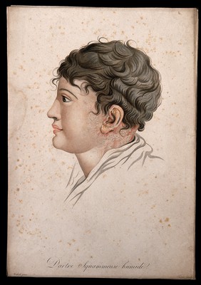 Head of a woman with a skin disease on her neck. Coloured stipple engraving by S. Tresca after Moreau-Valvile, c. 1806.