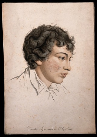 Head of a man with a skin disease on his cheek. Coloured stipple engraving by S. Tresca after Moreau-Valvile, c. 1806.