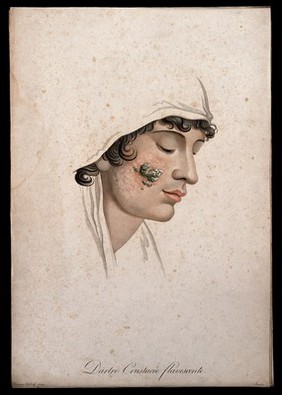 Head of a woman with a skin disease on her cheek. Coloured stipple engraving by S. Tresca after Moreau-Valvile, c. 1806.