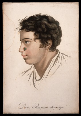 Head of a man with a skin disease on his nostril. Coloured stipple engraving by S. Tresca after Moreau-Valvile, c. 1806.