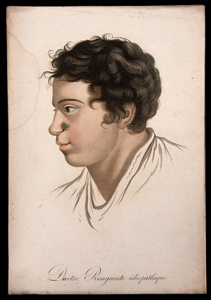 view Head of a man with a skin disease on his nostril. Coloured stipple engraving by S. Tresca after Moreau-Valvile, c. 1806.