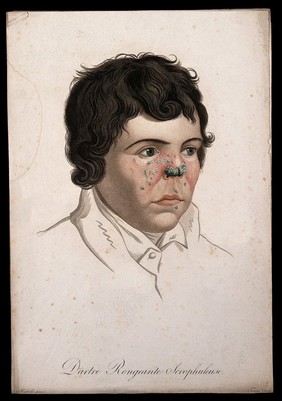 Head of a man with a skin disease on his nose. Coloured stipple engraving by S. Tresca after Moreau-Valvile, c. 1806.