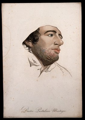 Head of a man with a skin disease on his chin. Coloured stipple engraving by S. Tresca after Moreau-Valvile, c. 1806.