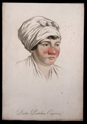 view Head of a woman with a skin disease on her nose. Coloured stipple engraving by S. Tresca after Moreau-Valvile, c. 1806.