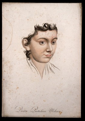 Head of a woman with a skin disease on her forehead. Coloured stipple engraving by S. Tresca after Moreau-Valvile, c. 1806.
