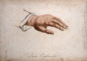 view A hand with a skin disease. Coloured stipple engraving by S. Tresca after Moreau-Valvile, c. 1806.