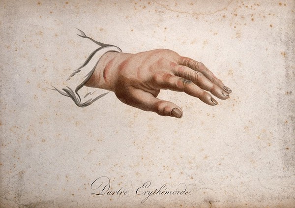 A hand with a skin disease. Coloured stipple engraving by S. Tresca after Moreau-Valvile, c. 1806.