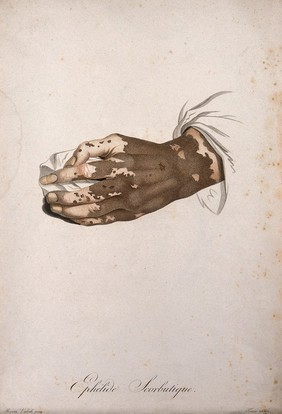 A hand with a skin disease. Coloured stipple engraving by S. Tresca after Moreau-Valvile, c. 1806.