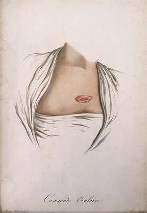 view A chest with an area of skin disease. Coloured stipple engraving by S. Tresca after Moreau-Valvile, c. 1806.