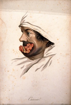 view Head of a man with a skin disease on his mouth. Coloured stipple engraving by S. Tresca after Moreau-Valvile, c. 1806.