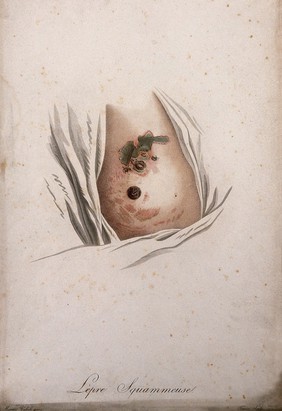 A breast with an area of skin disease. Coloured stipple engraving by S. Tresca after Moreau-Valvile, c. 1806.