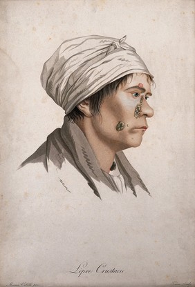 A head of a woman with a skin disease on her face and neck. Coloured stipple engraving by S. Tresca after Moreau-Valvile, c. 1806.