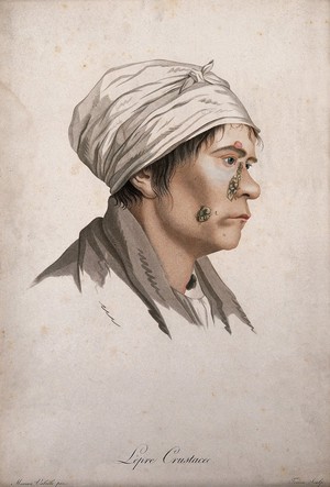 view A head of a woman with a skin disease on her face and neck. Coloured stipple engraving by S. Tresca after Moreau-Valvile, c. 1806.