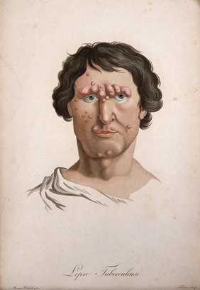 A head of a man with a skin disease on his face. Coloured stipple engraving by S. Tresca after Moreau-Valvile, c. 1806.